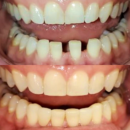 invisalign before and after photo
